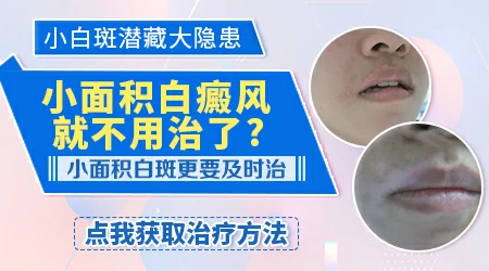 初期白癜风只有指甲盖大小用治疗吗