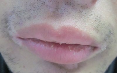口唇白斑初期症状 白斑可以治好吗