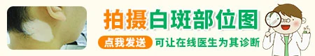 宝宝会长白癜风吗 儿童白斑病因