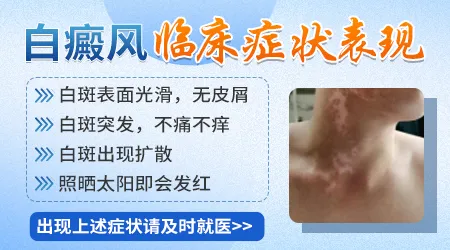 怎么判断白斑是不是白癜风