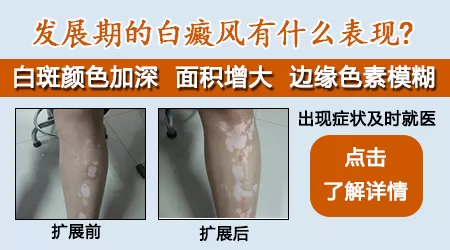 白癜风扩散的征兆是什么
