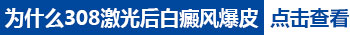 308激光治疗白癜风一次需要多少钱