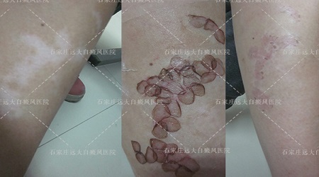 面部白癜风照光好还是种植好