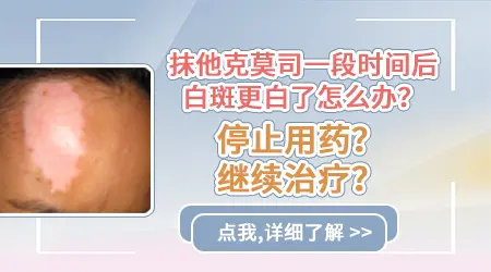 涂他克莫司白斑面积越大还能用吗