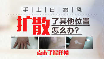 白癜风长在手上好治吗