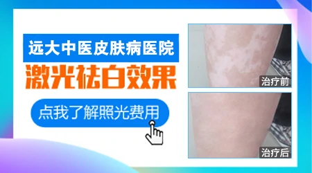 白癜风308激光后恢复变化图