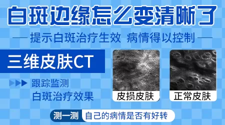 白癜风边缘更清晰了怎么回事
