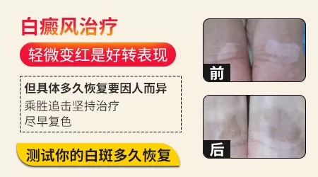 白癜风照光后白斑发红正常吗
