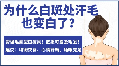 发现白色汗毛皮肤也白了一定是白癜风吗