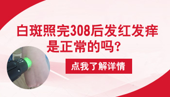 白癜风照了308红了有点痒是什么原因