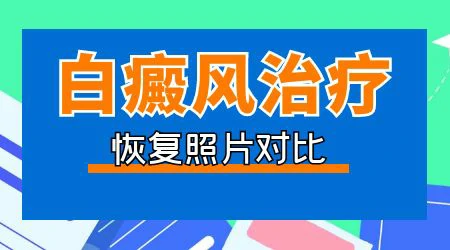 白斑做完光疗几个小时能洗澡