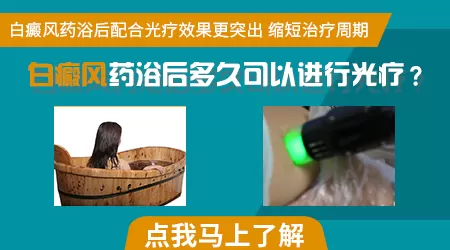 白癜风多长时间照射一次紫外线灯好