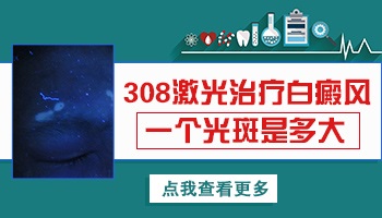 308激光照白癜风一个光斑有多大面积