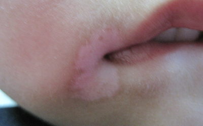 三岁宝宝嘴角皮肤有一块小白点