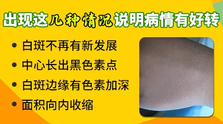 药物治疗白癜风的效果好不好