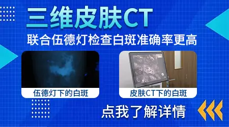 皮肤CT发现早期色素改变但伍德灯未检出是否正常