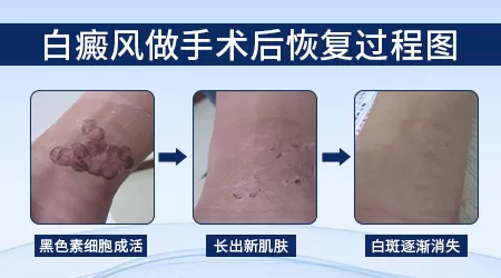 手指植皮手术后恢复图