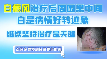白癜风恢复过程
