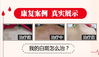 接种新冠疫苗对白癜风患者有影响吗