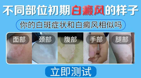 脖子后面皮肤白斑是不是白癜风