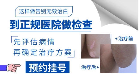 白癜风不治对人有哪些危害