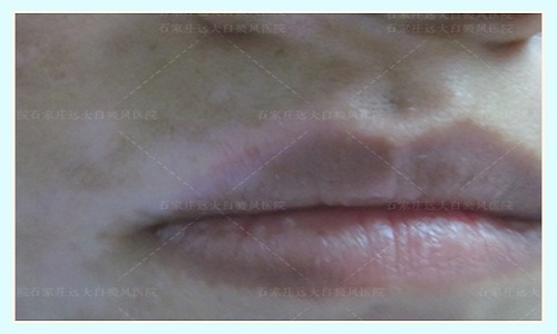 嘴角皮肤白斑症状图片