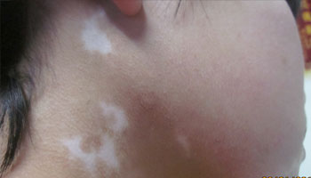 出生两个月的宝宝脖子皮肤上有黄豆大的白斑