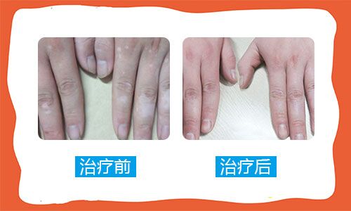 女性双手手指有白色的小点点是怎么回事