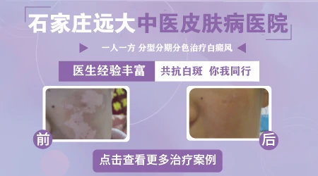 照光后白斑变红可以继续照吗