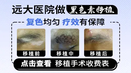 白癜风细胞移植可以照光吗