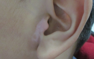 三岁孩子耳朵附近皮肤比脸白很多