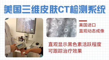 白癜风移植手术一个月还白