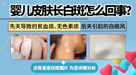 宝宝腿上白斑是怎么了