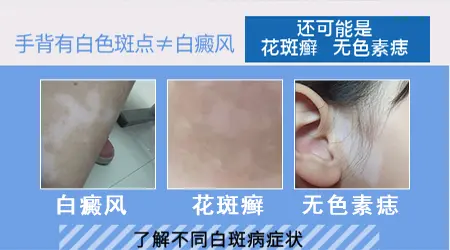 早期手上白斑什么原因