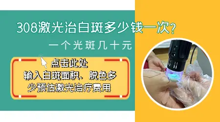 308激光治疗白斑一次多少钱