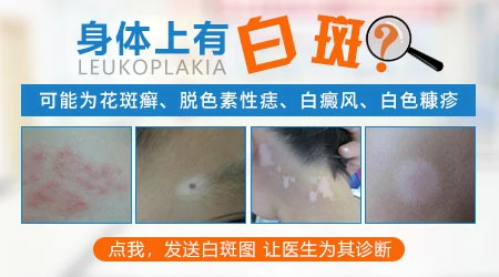 打完疫苗脖子出现一块白斑