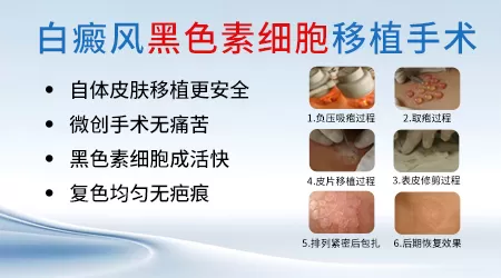 白癜风黑色素移植后会遗留瘢痕吗