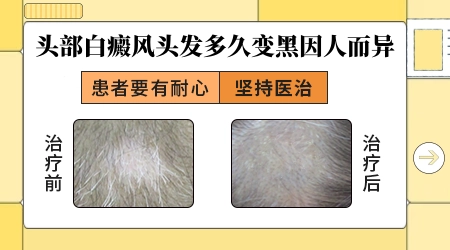 白癜风导致的白发会变黑吗