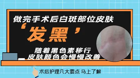 种植治白癜风恢复过程
