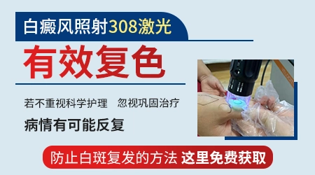 稳定期白癜风能用308激光吗