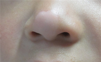 鼻梁中间有白色一块的是怎么了