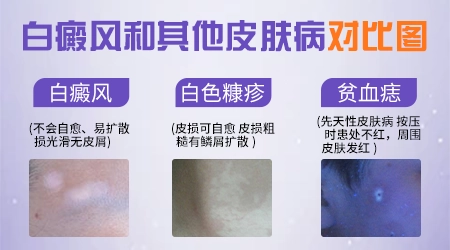 小腿长白斑点如何区分是什么病