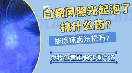 白癜风照光后起水泡怎么回事