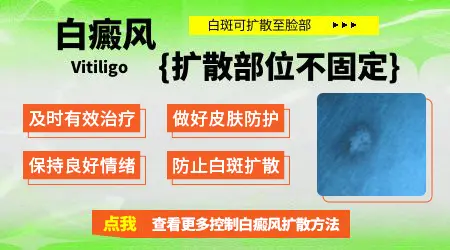 腿上的白癜风会不会长到脸上