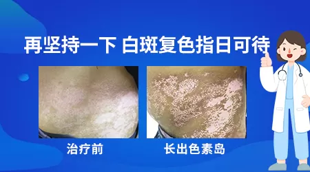 得了白癜风怎么补充黑色素
