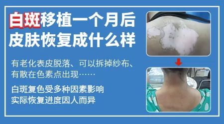 白癜风黑色素移植多久恢复正常皮肤