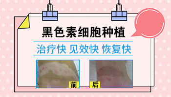 肢端型白癜风黑色素移植后的恢复图