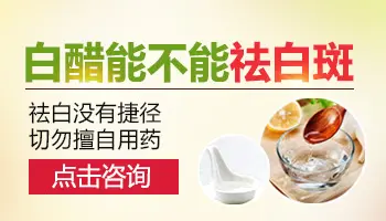 白醋可以治疗白癜风吗