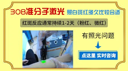 308激光治疗白癜风有效吗