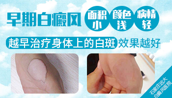 白癜风的早期症状表现都是什么样